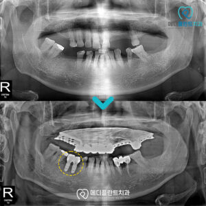 춘천수면치과-춘천메디플란트-증례