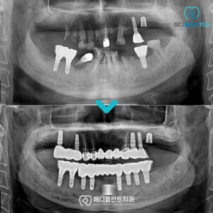 춘천수면치과-증례