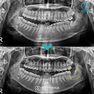 춘천수면사랑니