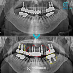 춘천수면임플란트