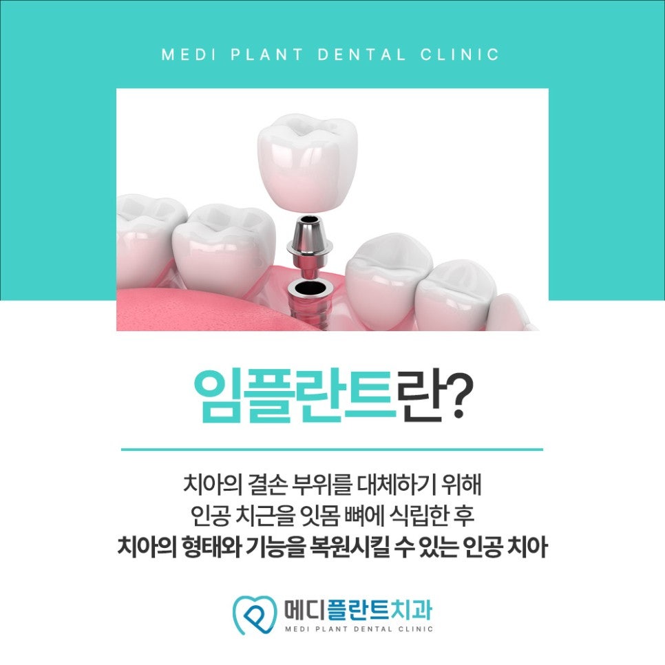 춘천임플란트 필요성을 높이는 치아 상실 원인과 젊을 때부터 꼼꼼한 관리 방법